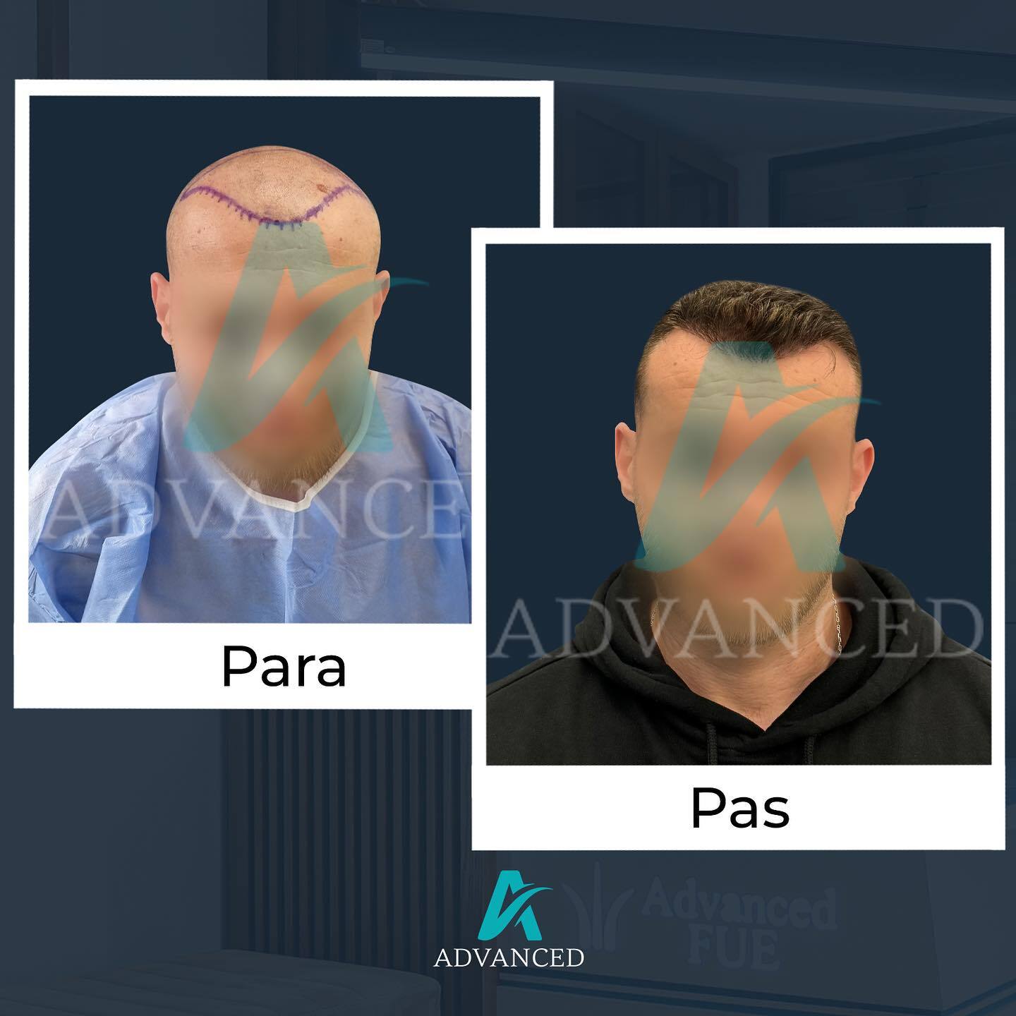 Advanced Hair Transplant photo 1