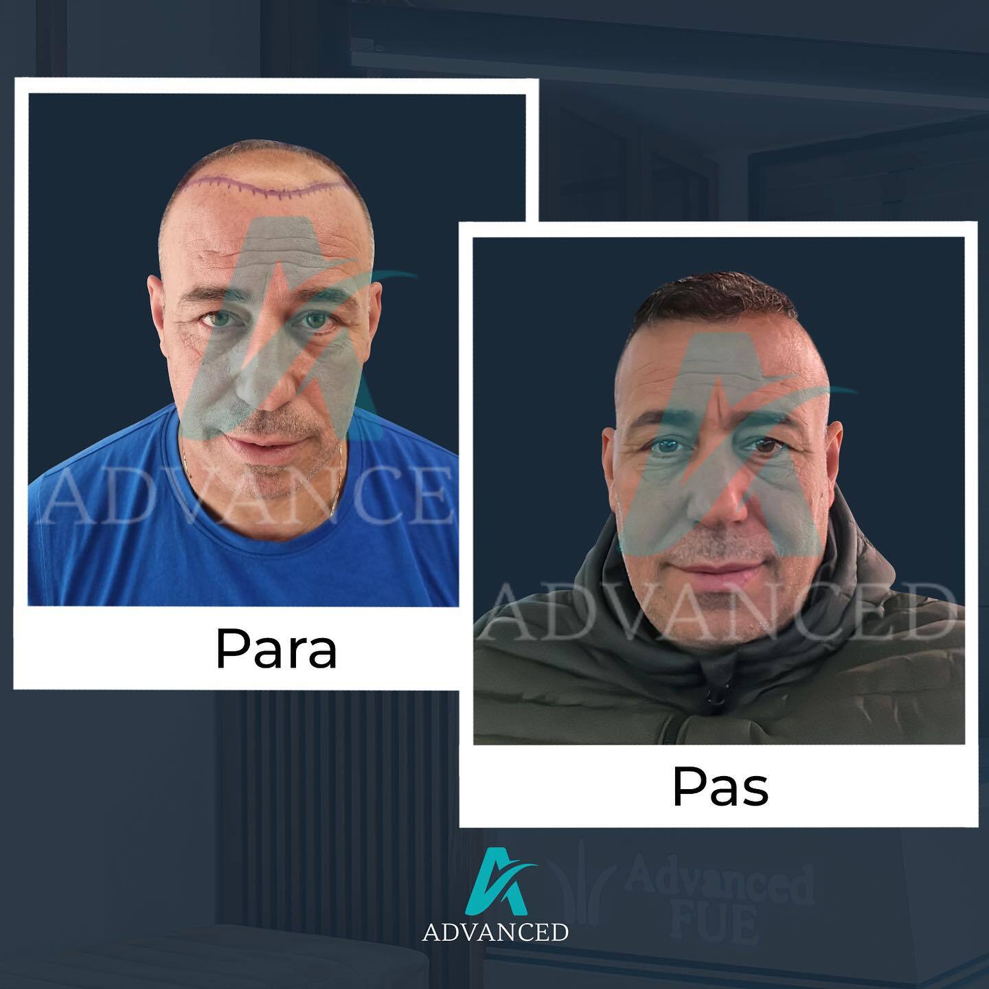 Advanced Hair Transplant photo 2