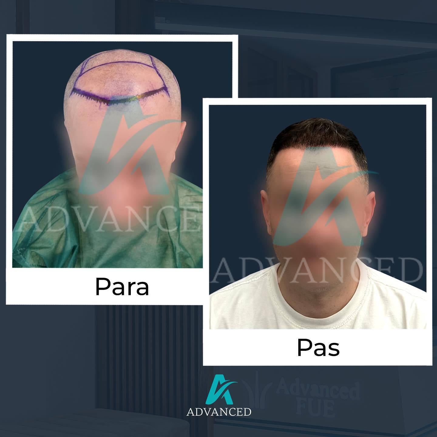 Advanced Hair Transplant photo 3