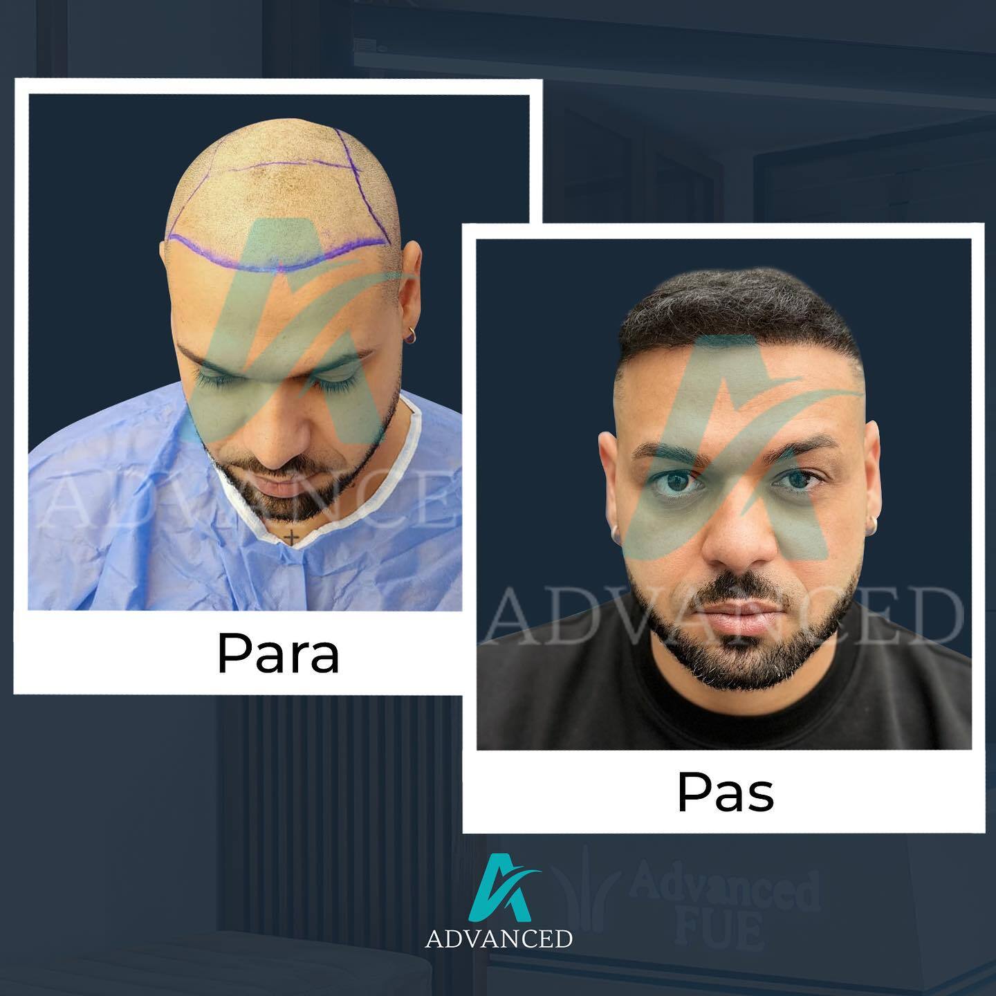 Advanced Hair Transplant photo 4