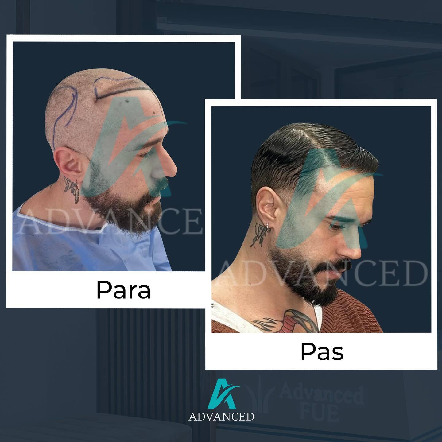 Advanced Hair Transplant photo 5