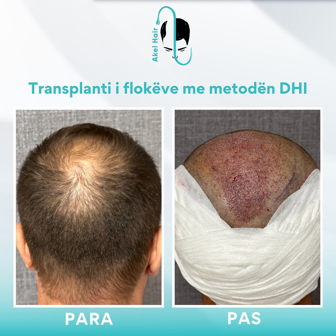 Akel Hair Clinic Tirana photo 1