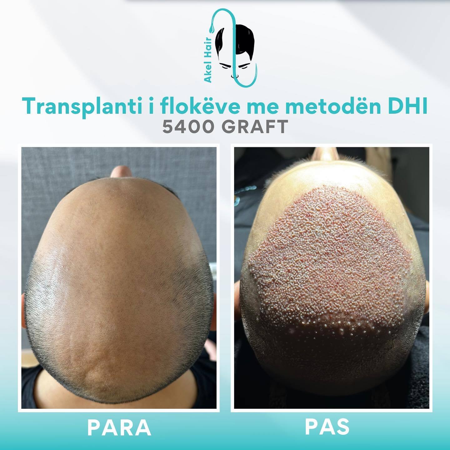 Akel Hair Clinic Tirana photo 2