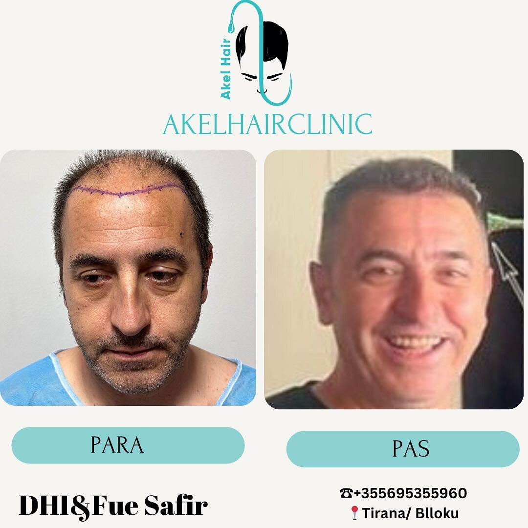 Akel Hair Clinic Tirana photo 3