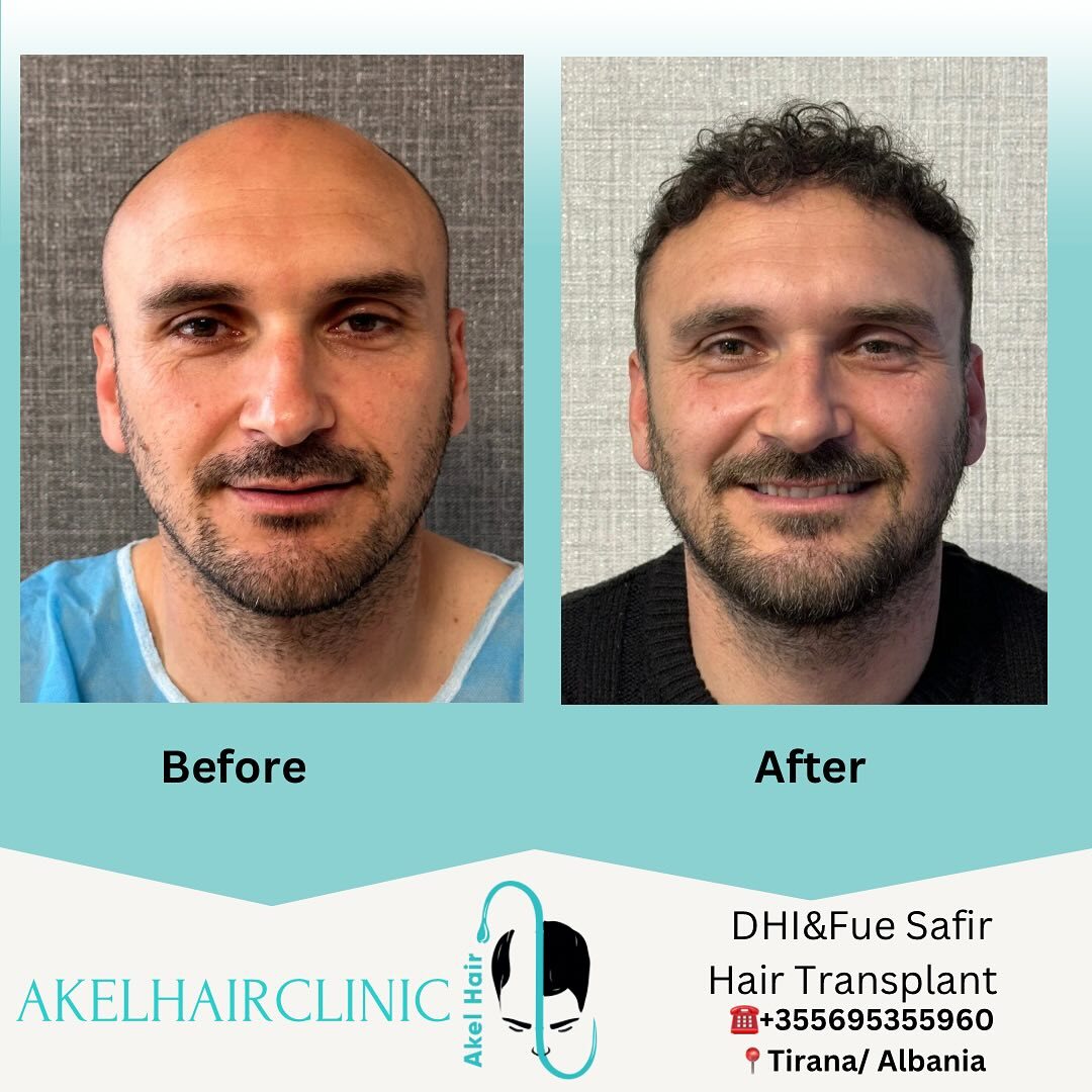 Akel Hair Clinic Tirana photo 4
