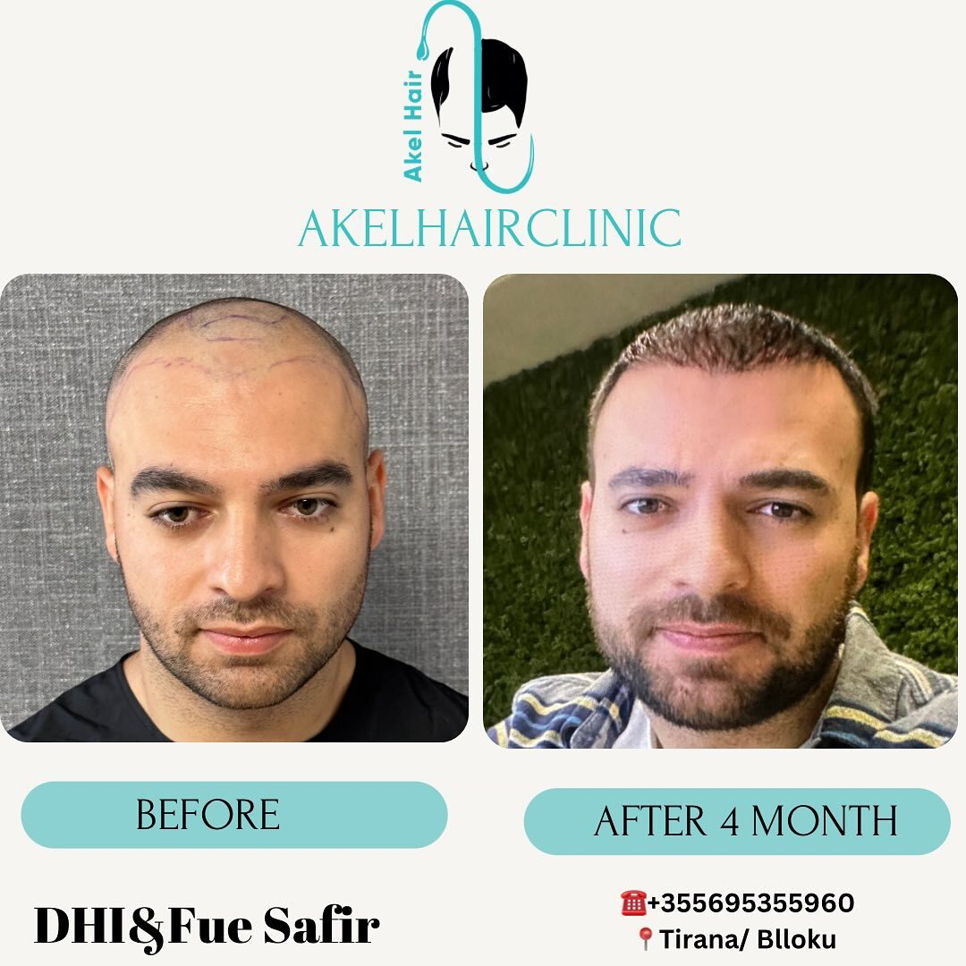 Akel Hair Clinic Tirana photo 5
