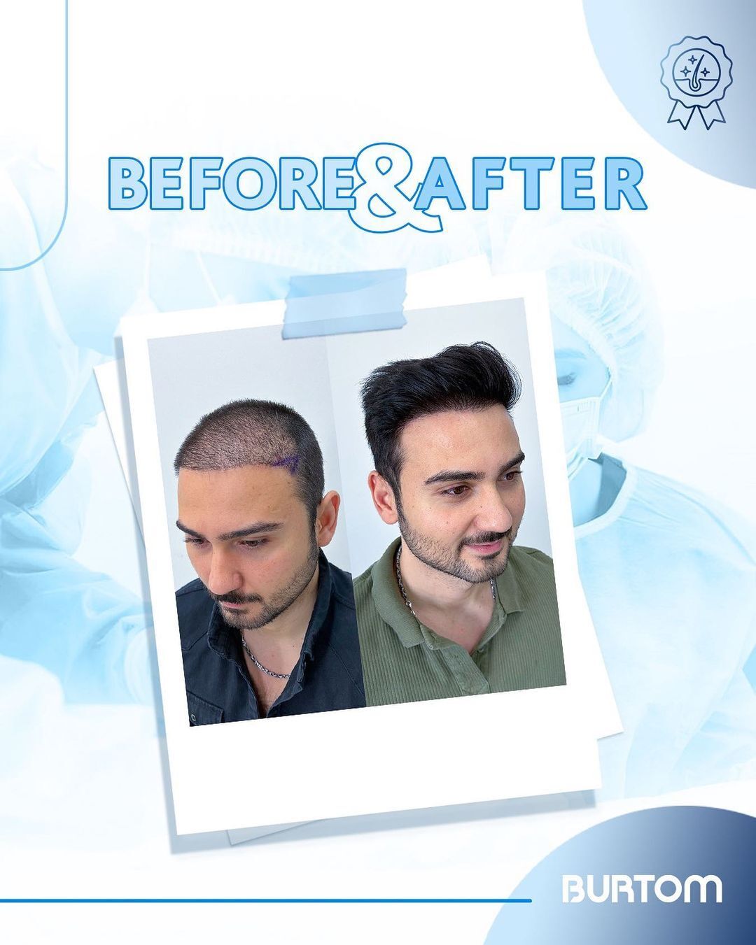 Burtom Hair Transplant Center photo 1
