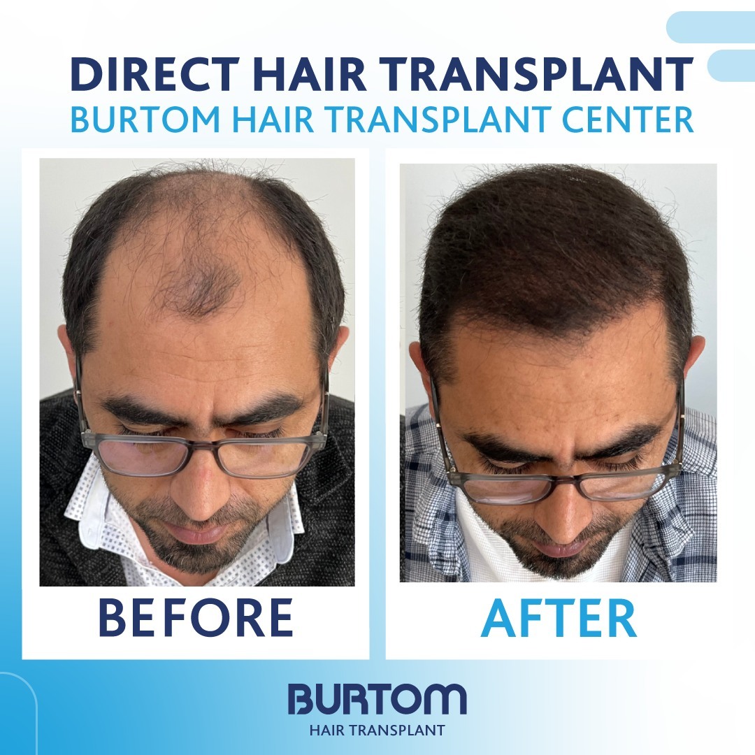 Burtom Hair Transplant Center photo 2