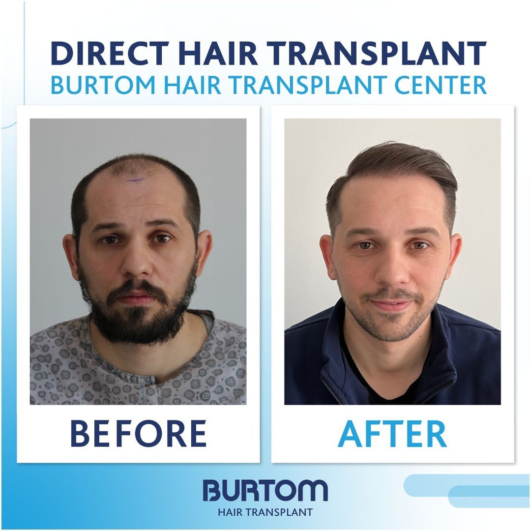 Burtom Hair Transplant Center photo 3