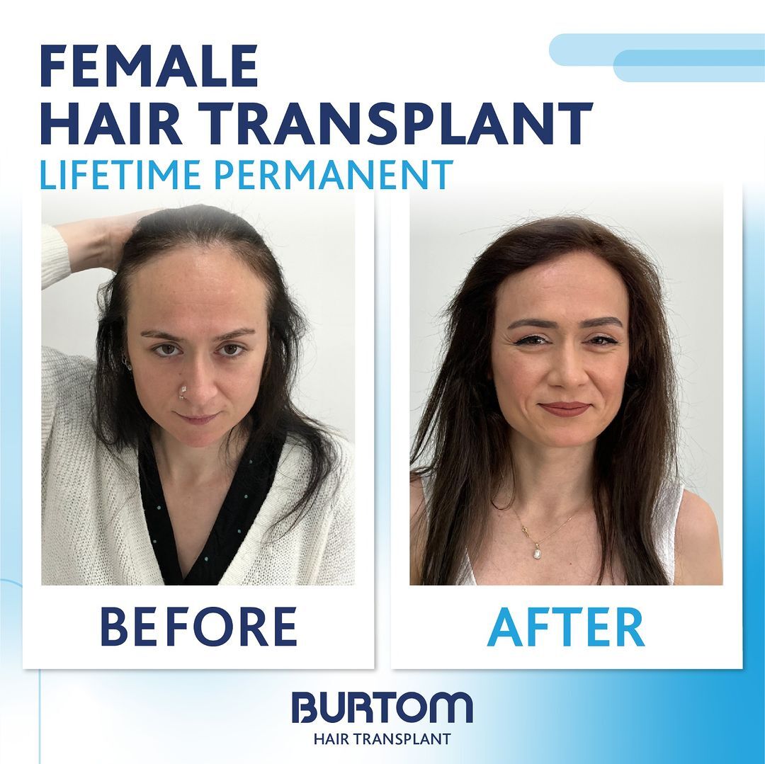 Burtom Hair Transplant Center photo 4