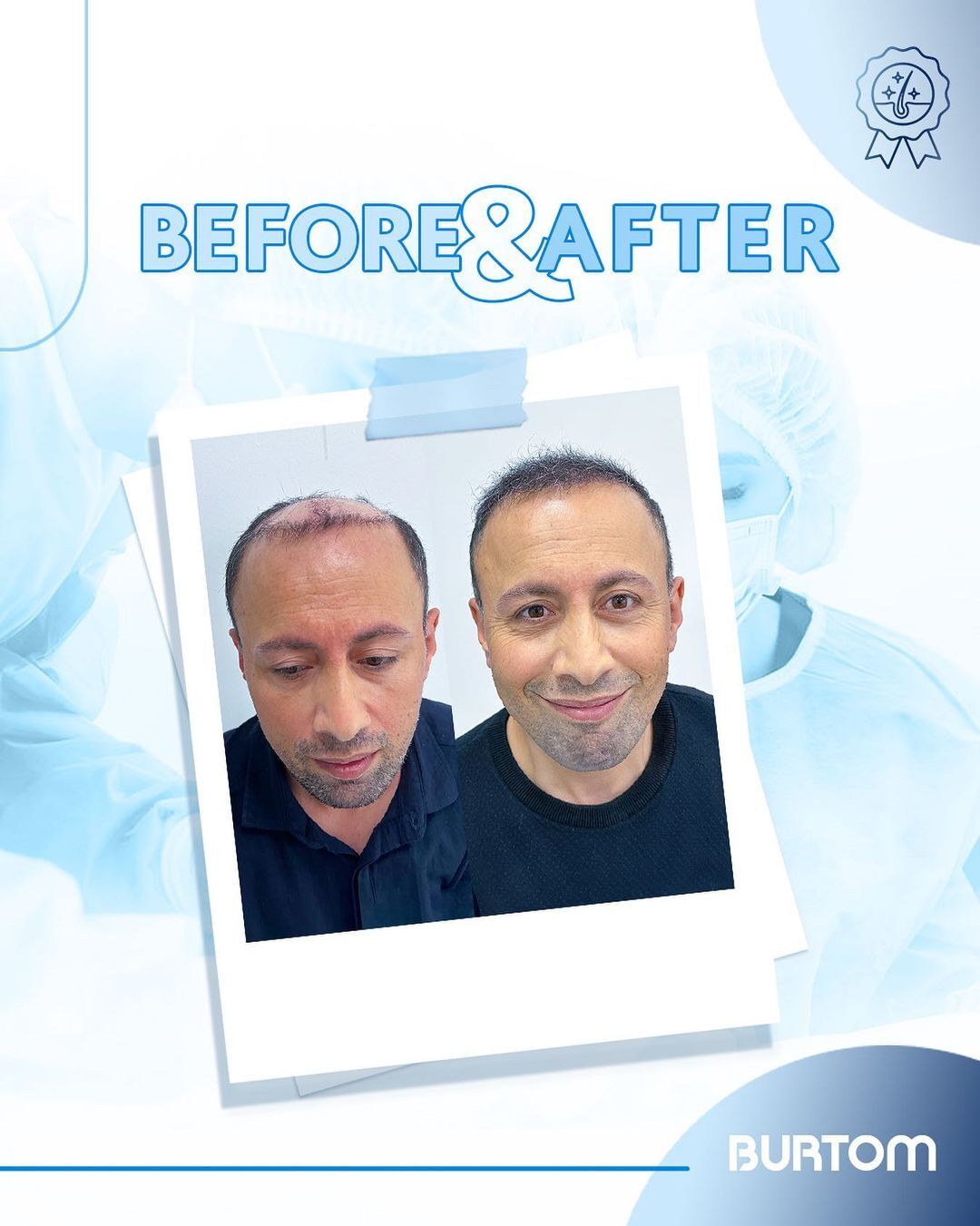 Burtom Hair Transplant Center photo 5
