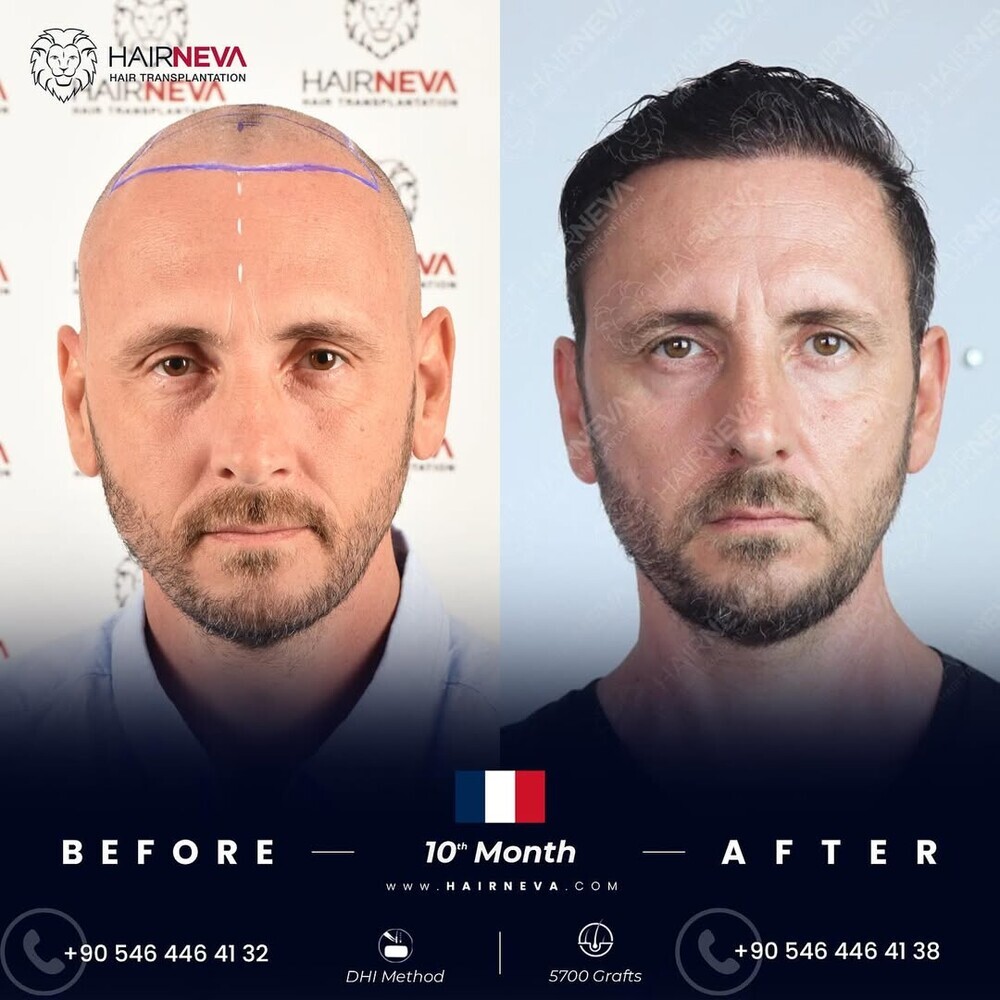 HairNeva Hair Transplant photo 1
