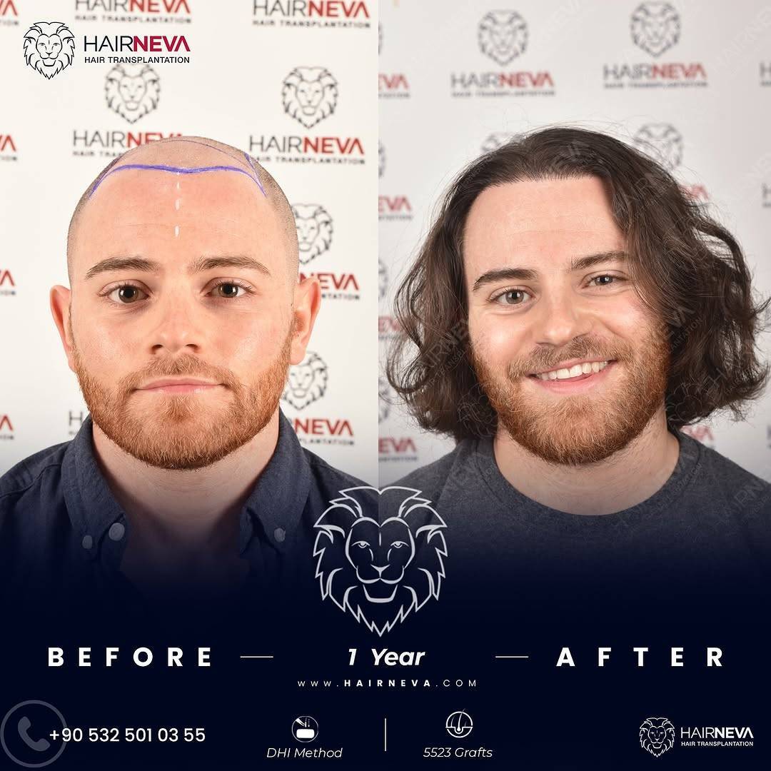 HairNeva Hair Transplant photo 2