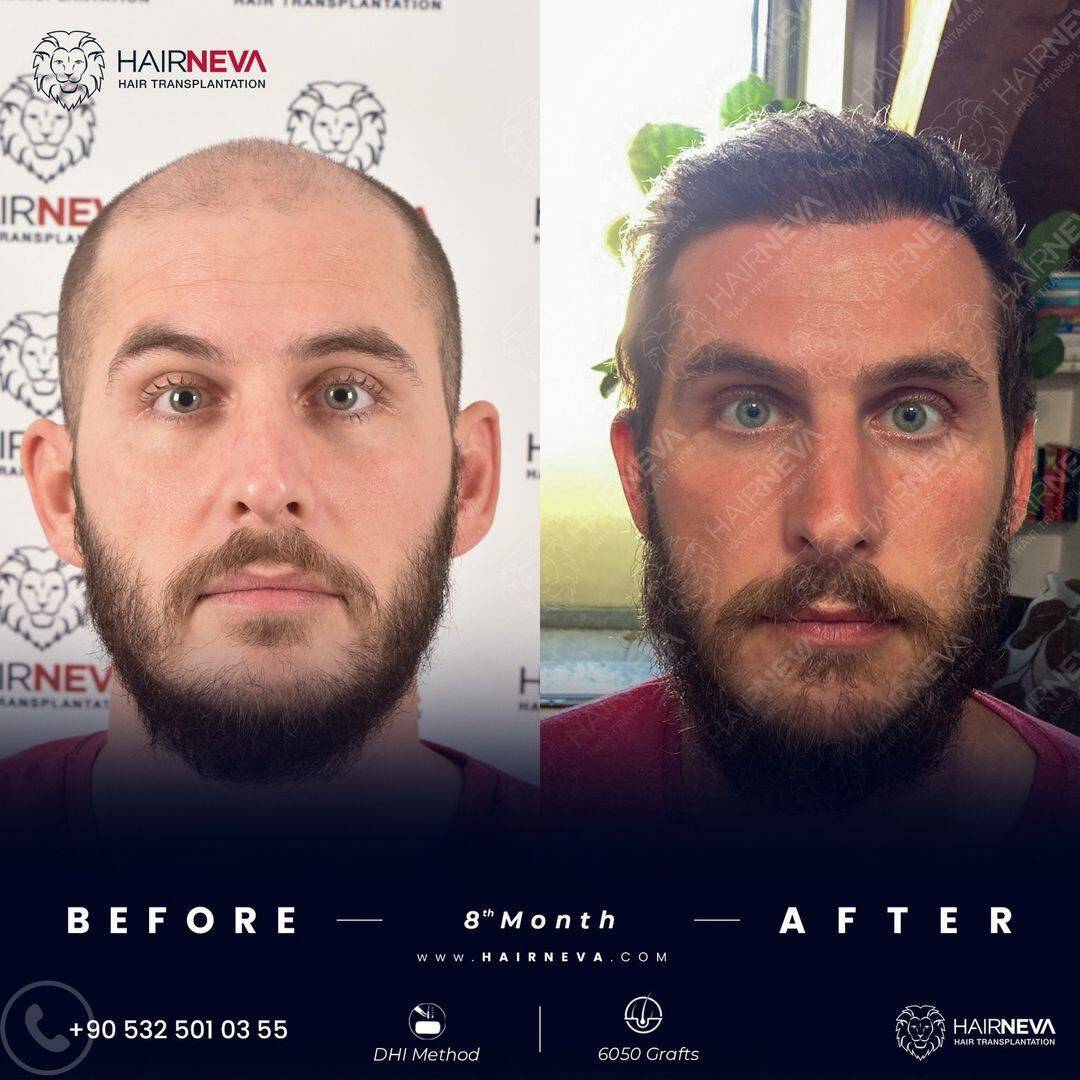HairNeva Hair Transplant photo 4