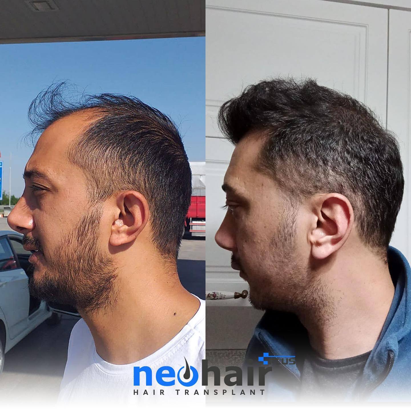 NeoHair Plus Hair Transplant photo 2