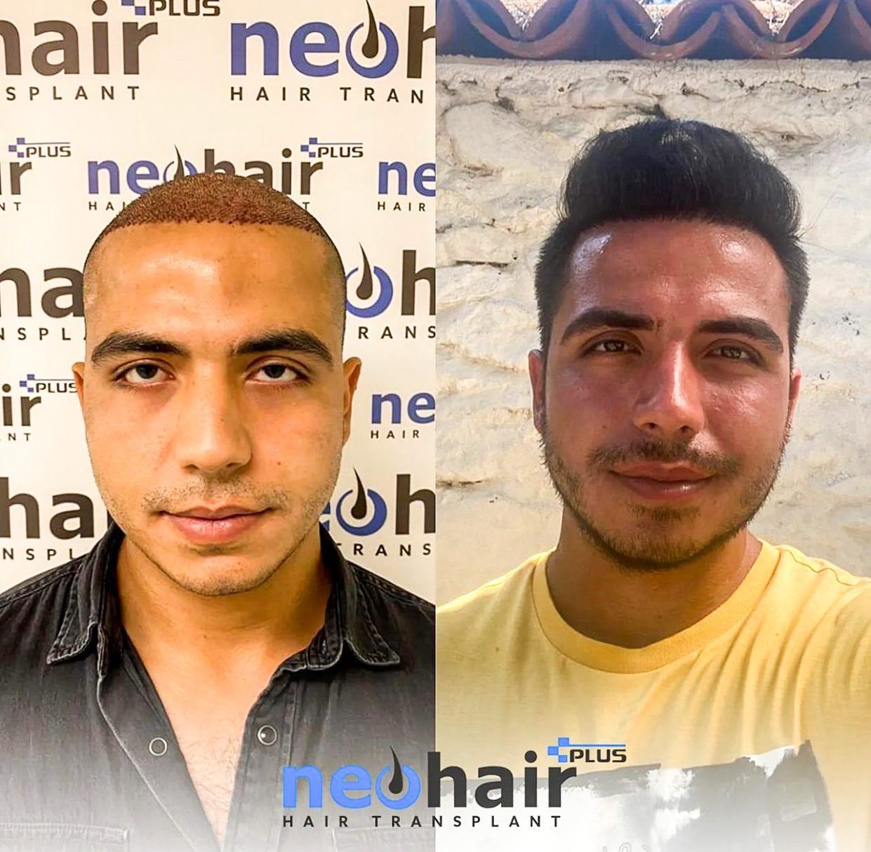NeoHair Plus Hair Transplant photo 3