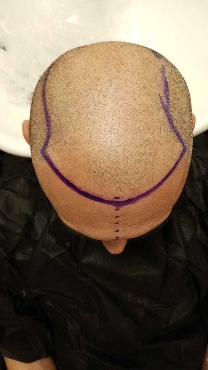 Tuğba Hair Transplant photo 1