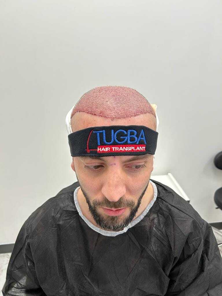 Tuğba Hair Transplant photo 2