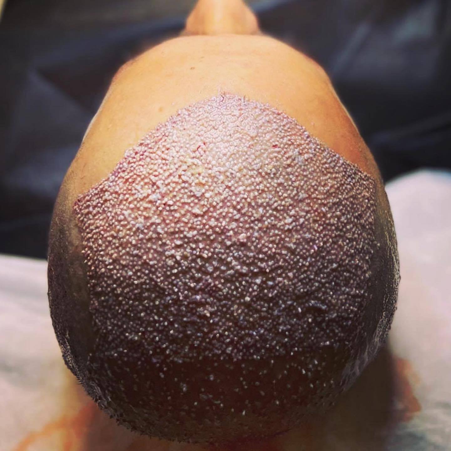 Tuğba Hair Transplant photo 3