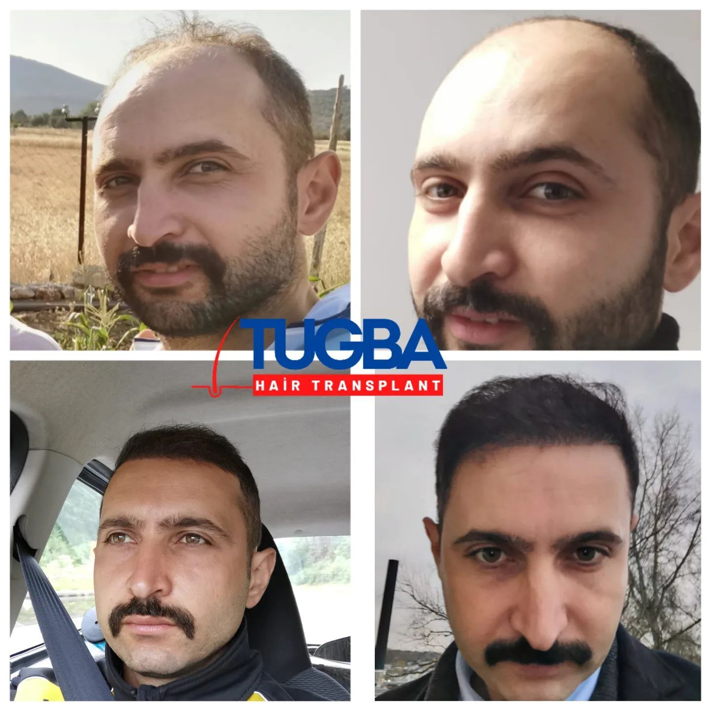 Tuğba Hair Transplant photo 5