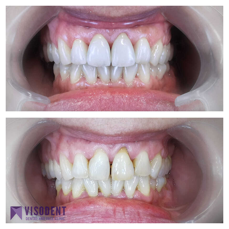 Visodent photo 2